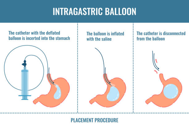 Intragastric Balloon surgery Dubai